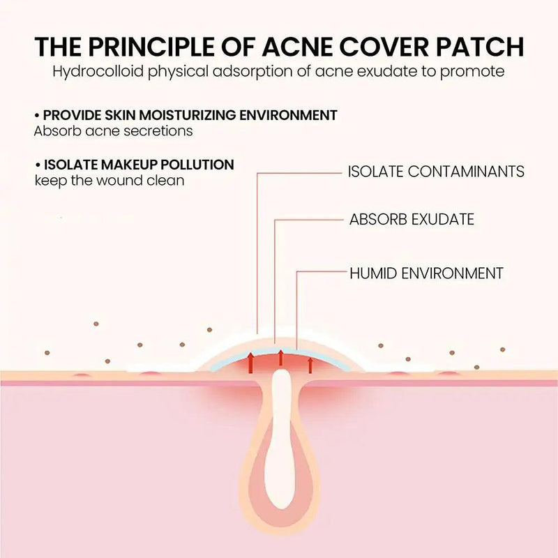 JAYSUING© Acne Pimple Patch - The Ultimate Solution for Blemishes - Cindorium